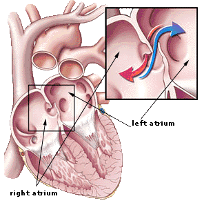 GtB PFO Patent foramen ovale